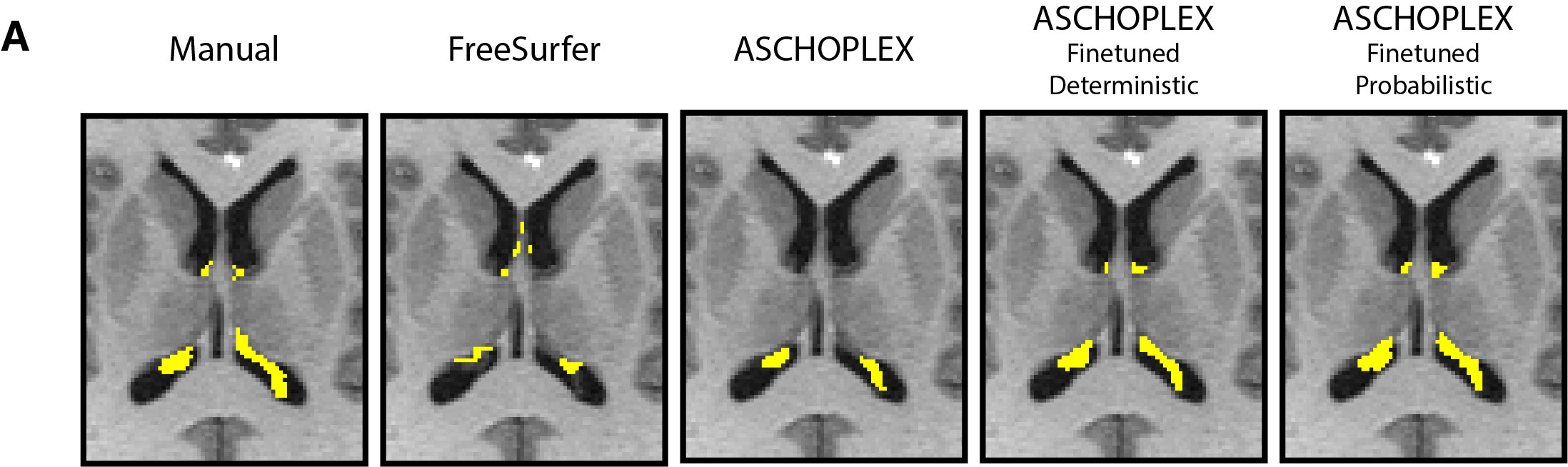 maps comparing choroid plexus segmentations